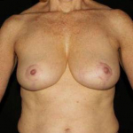 Breast Reduction - Case #2 After